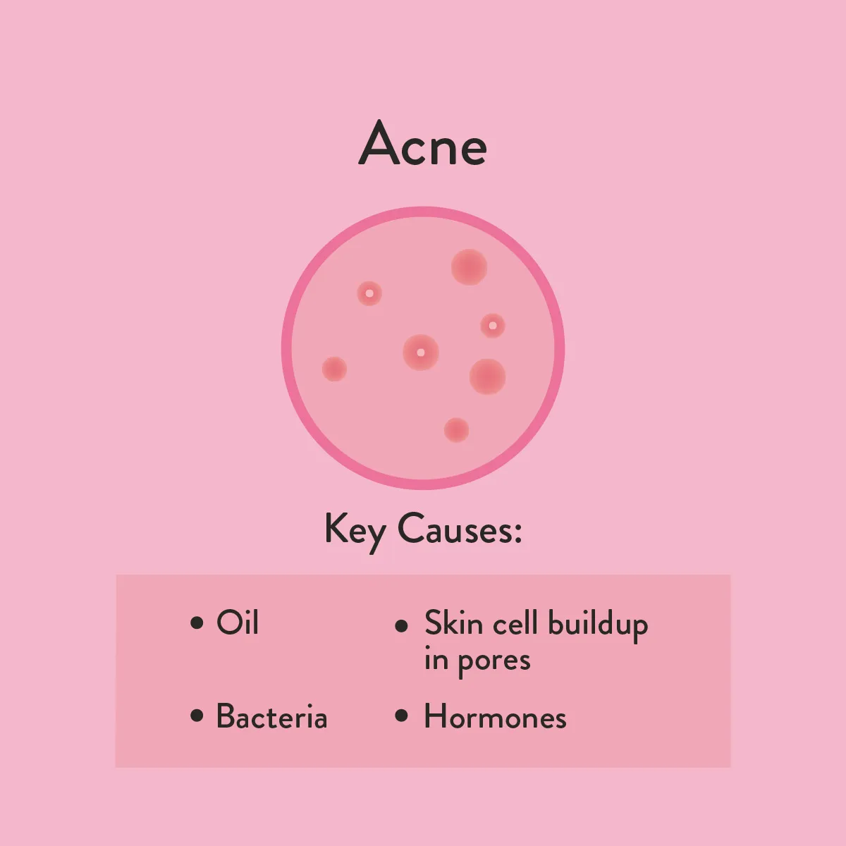 Acne Key Causes