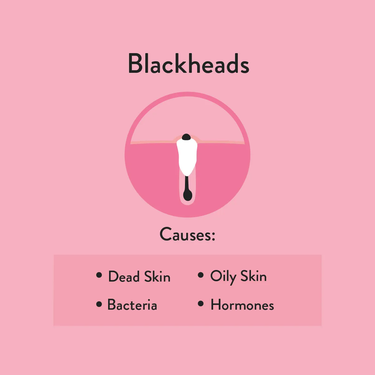 ‚What causes blackheads‘ informative diagram