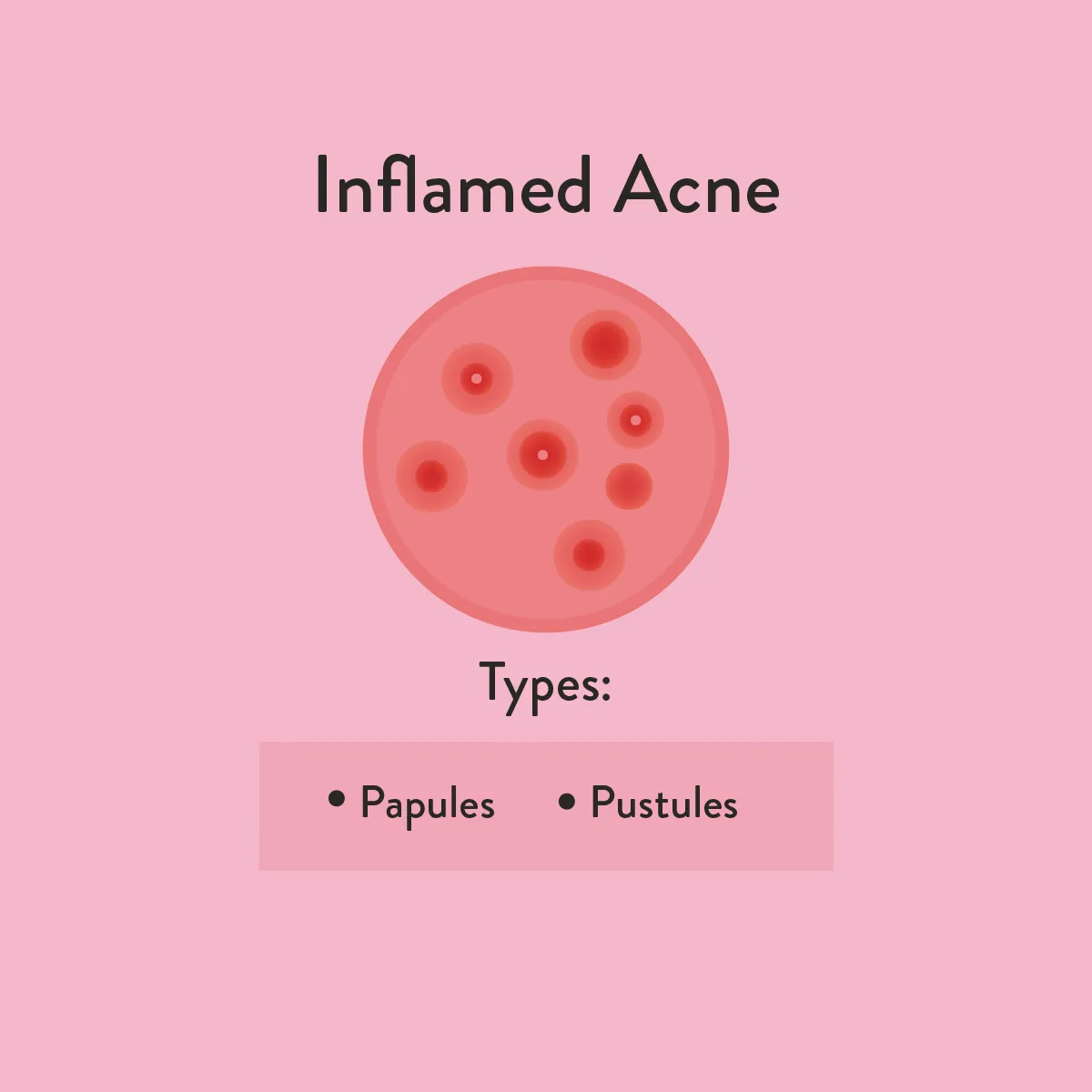 Inflamed acne  informative diagram