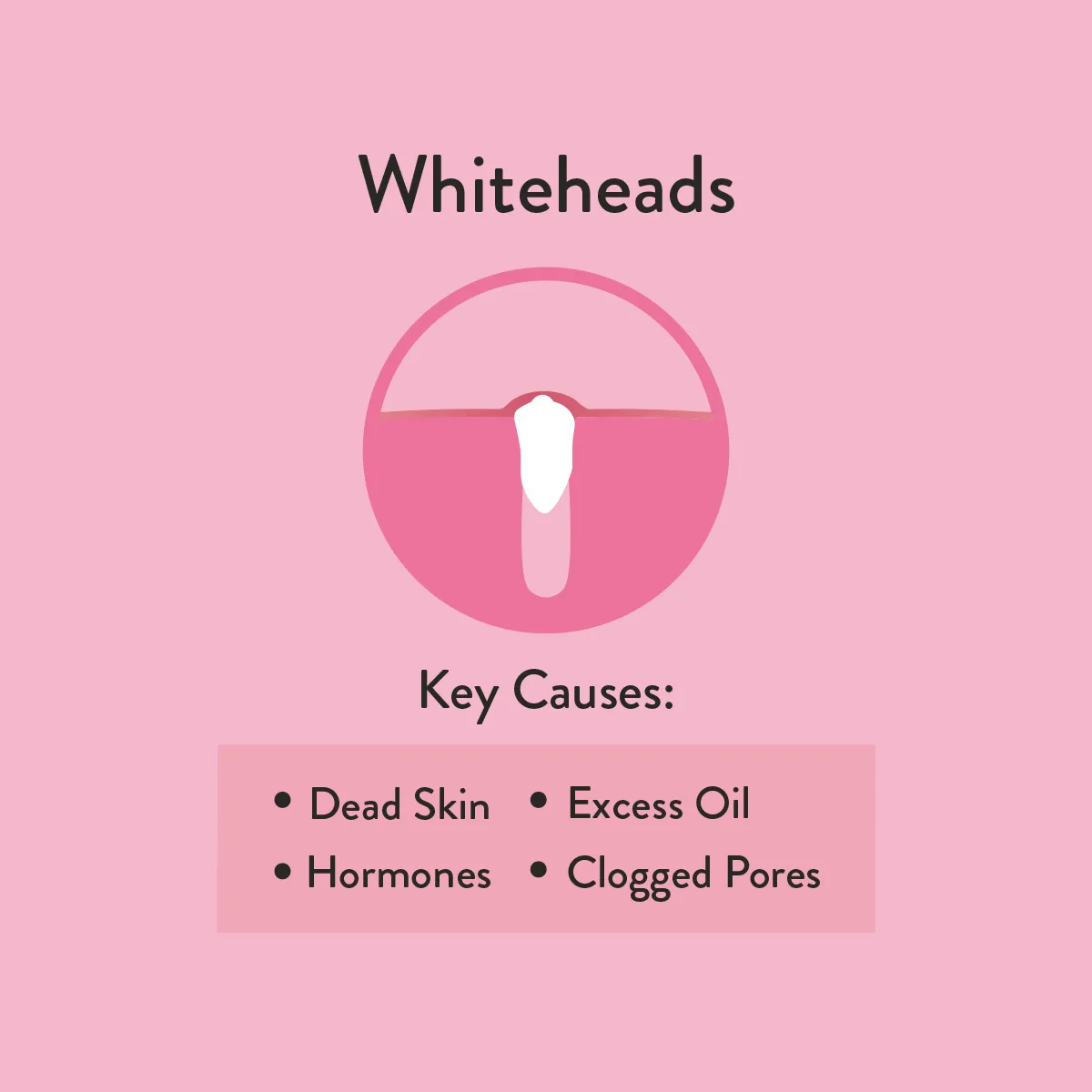Key causes of whiteheads 